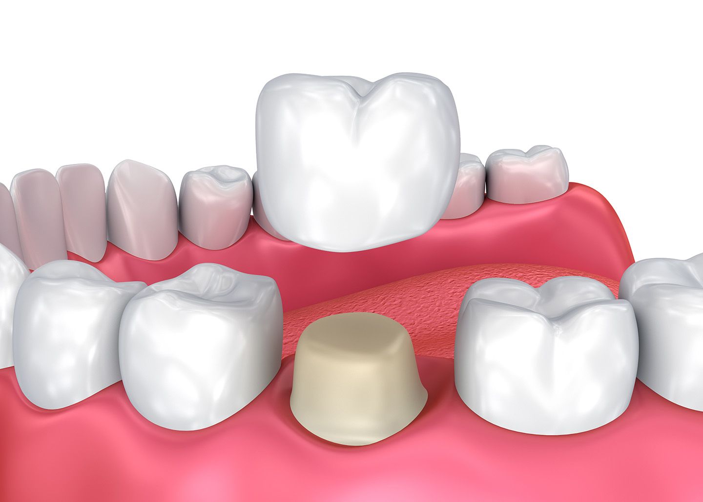 dental-crown4-3