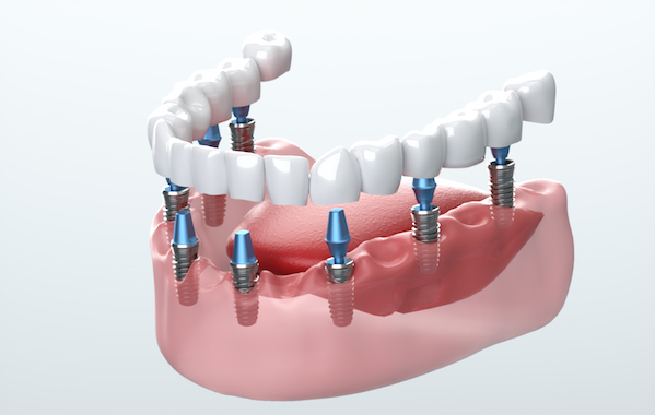 Digital generated image of ceramic dental veneers installation process on white background.